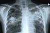 Chest xray with TB