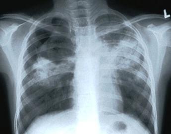 Chest xray with TB